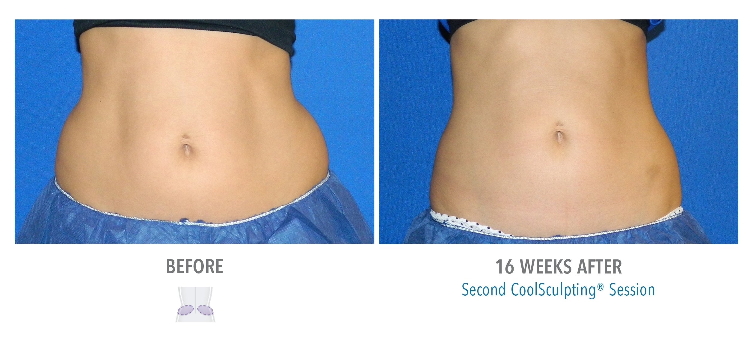 Liposuction Orlando